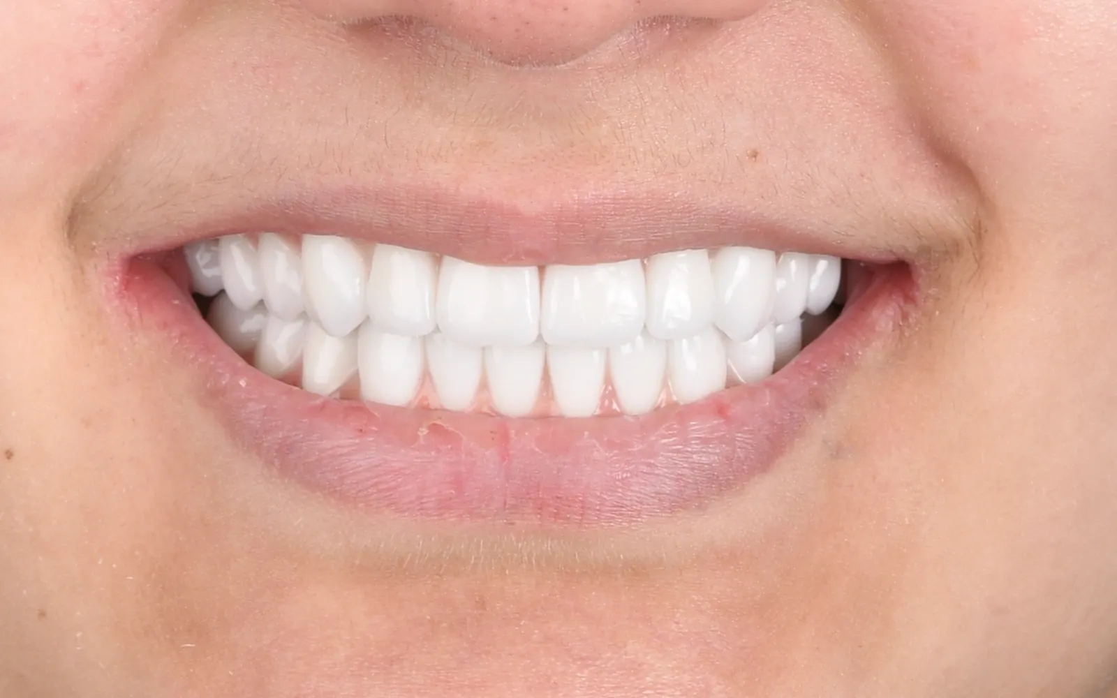 After: Smile makeover, case 1: an even, natural-looking full smile at Cleburne Dental
