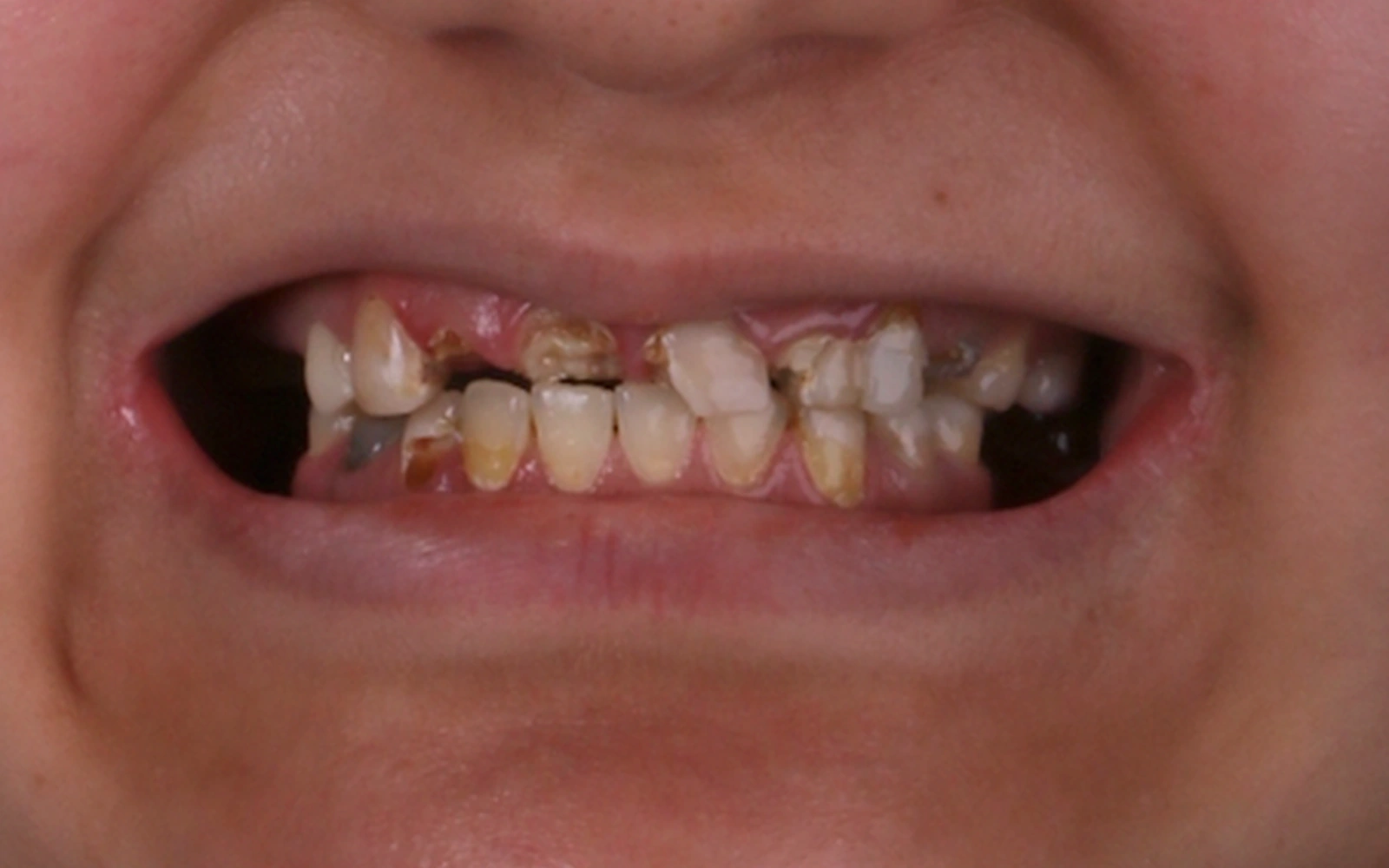 Before: Smile makeover, case 1: broken, decayed and missing teeth
