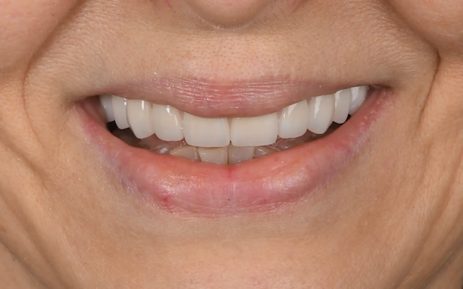 After: Smile makeover, case 7: an even, natural-looking full smile at Cleburne Dental