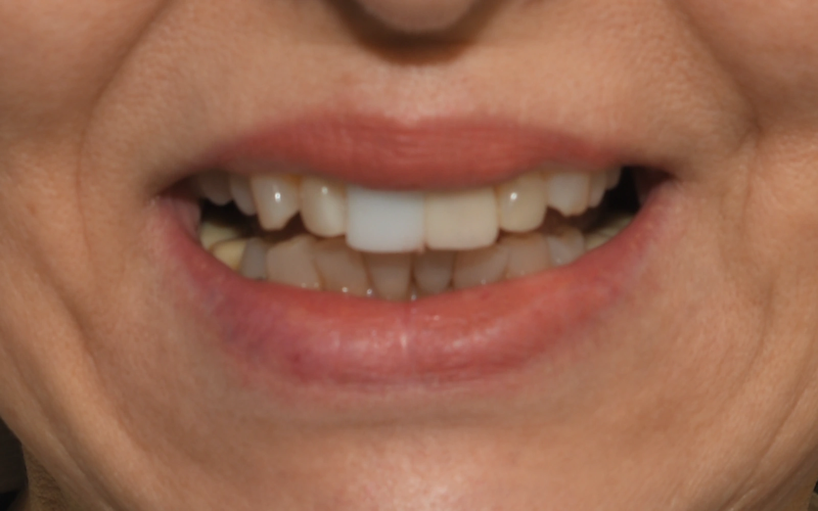 Before: Smile makeover, case 7: uneven, discolored teeth with a mismatched front tooth