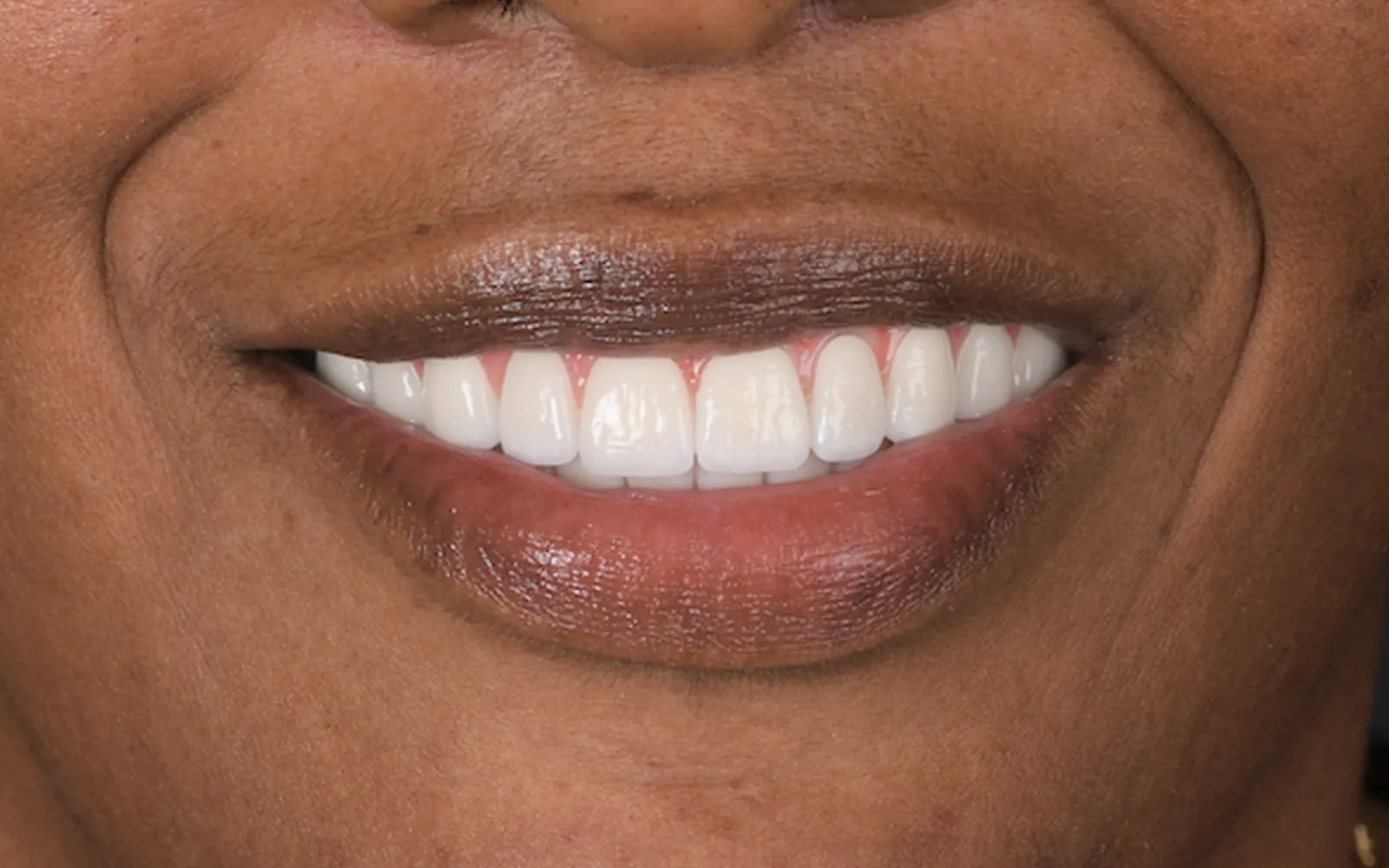 After: Smile makeover, case 3: an even, natural-looking full smile at Cleburne Dental