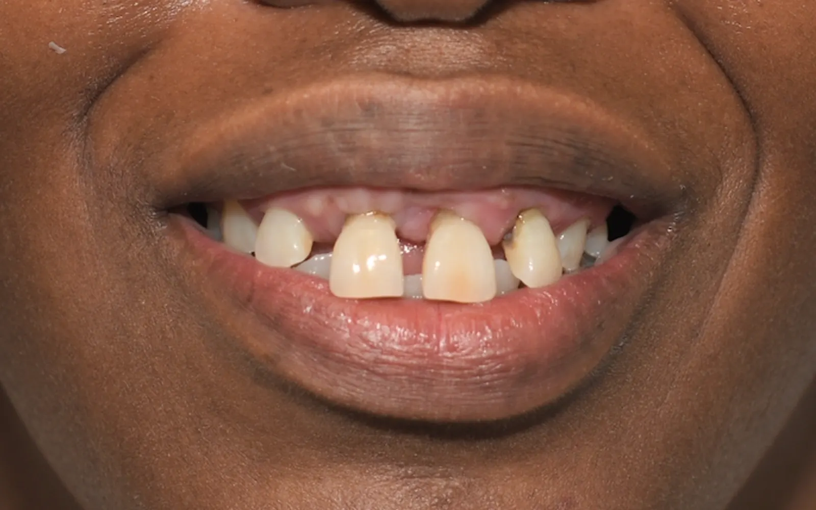 Before: Smile makeover, case 3: missing and widely spaced front teeth