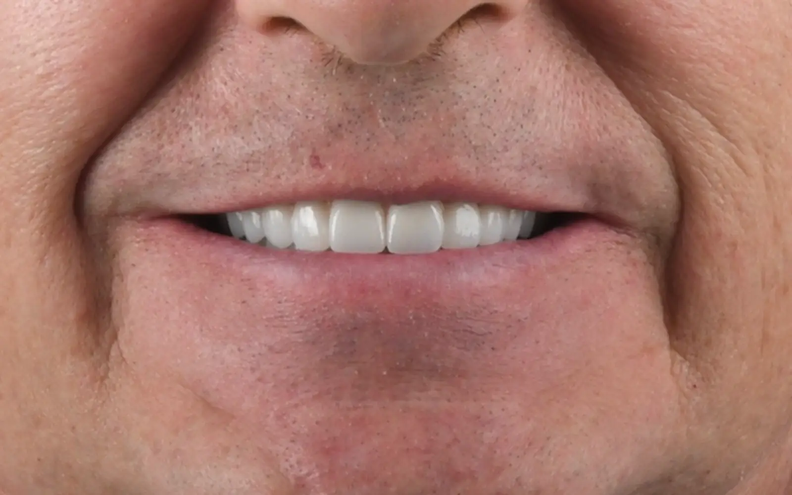 After: Smile makeover, case 18: an even, natural-looking full smile at Cleburne Dental