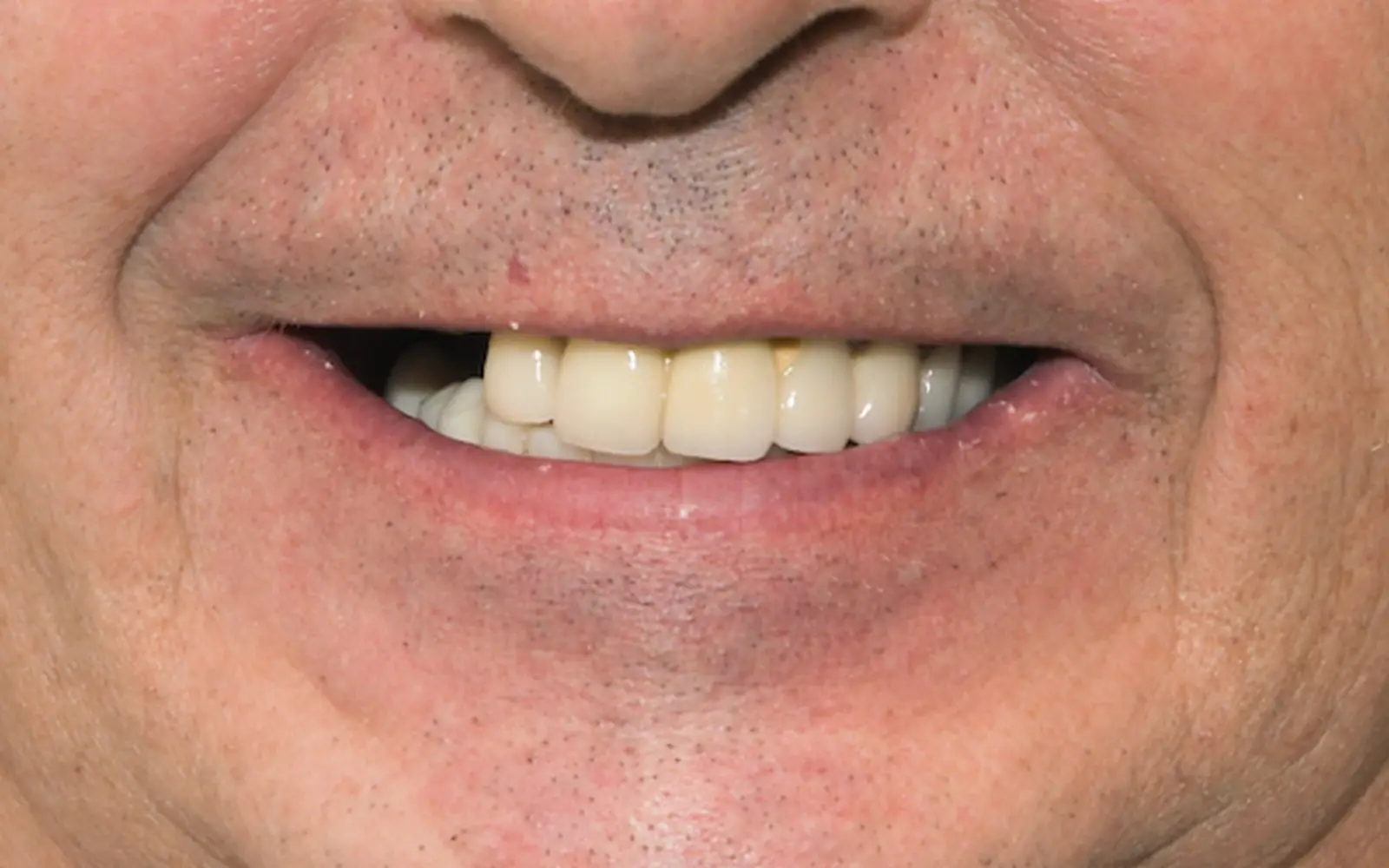 Before: Smile makeover, case 18: dark, worn older dental work