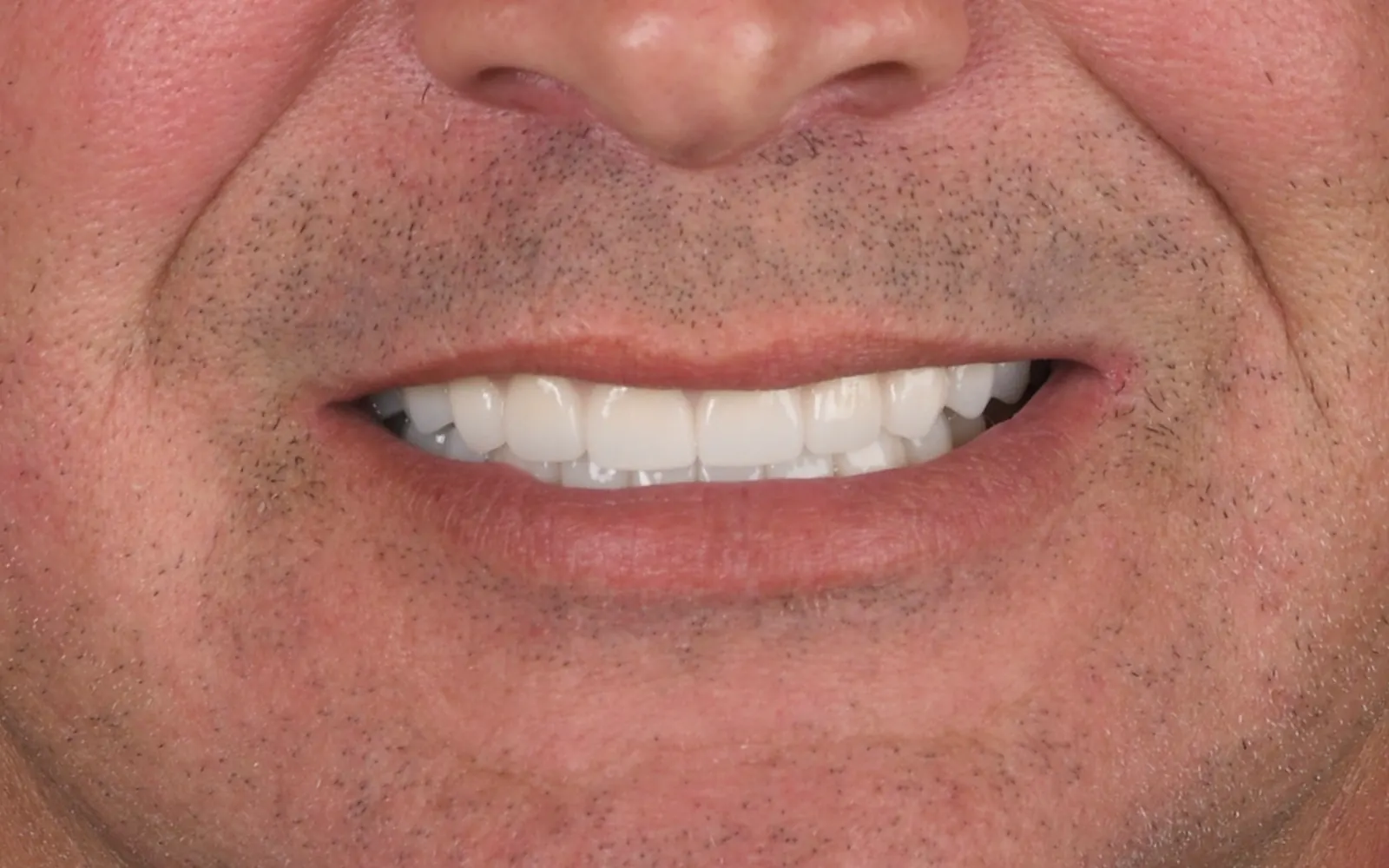 After: Smile makeover, case 14: an even, natural-looking full smile at Cleburne Dental