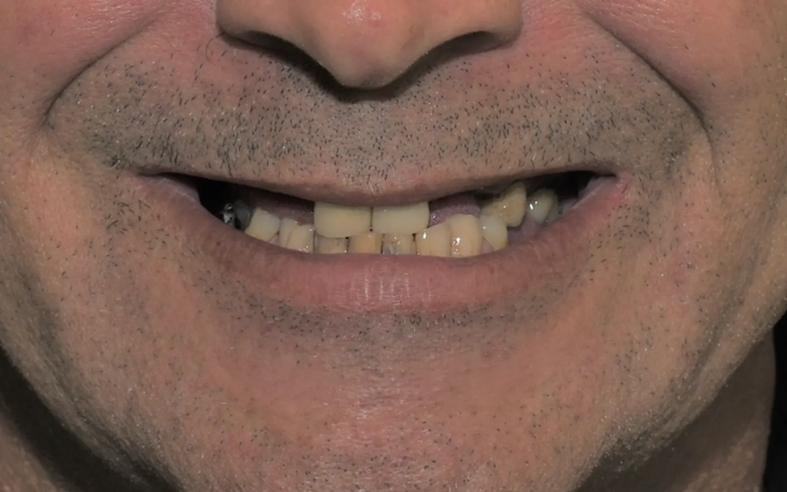 Before: Smile makeover, case 14: missing and darkened teeth
