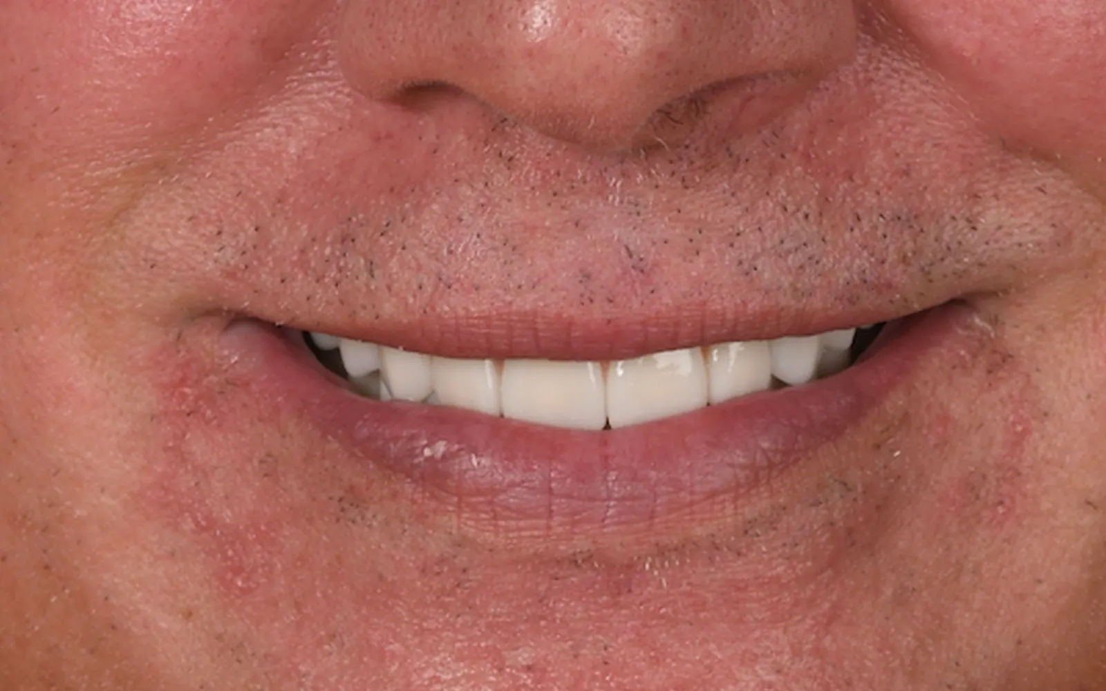 After: Smile makeover, case 8: an even, natural-looking full smile at Cleburne Dental