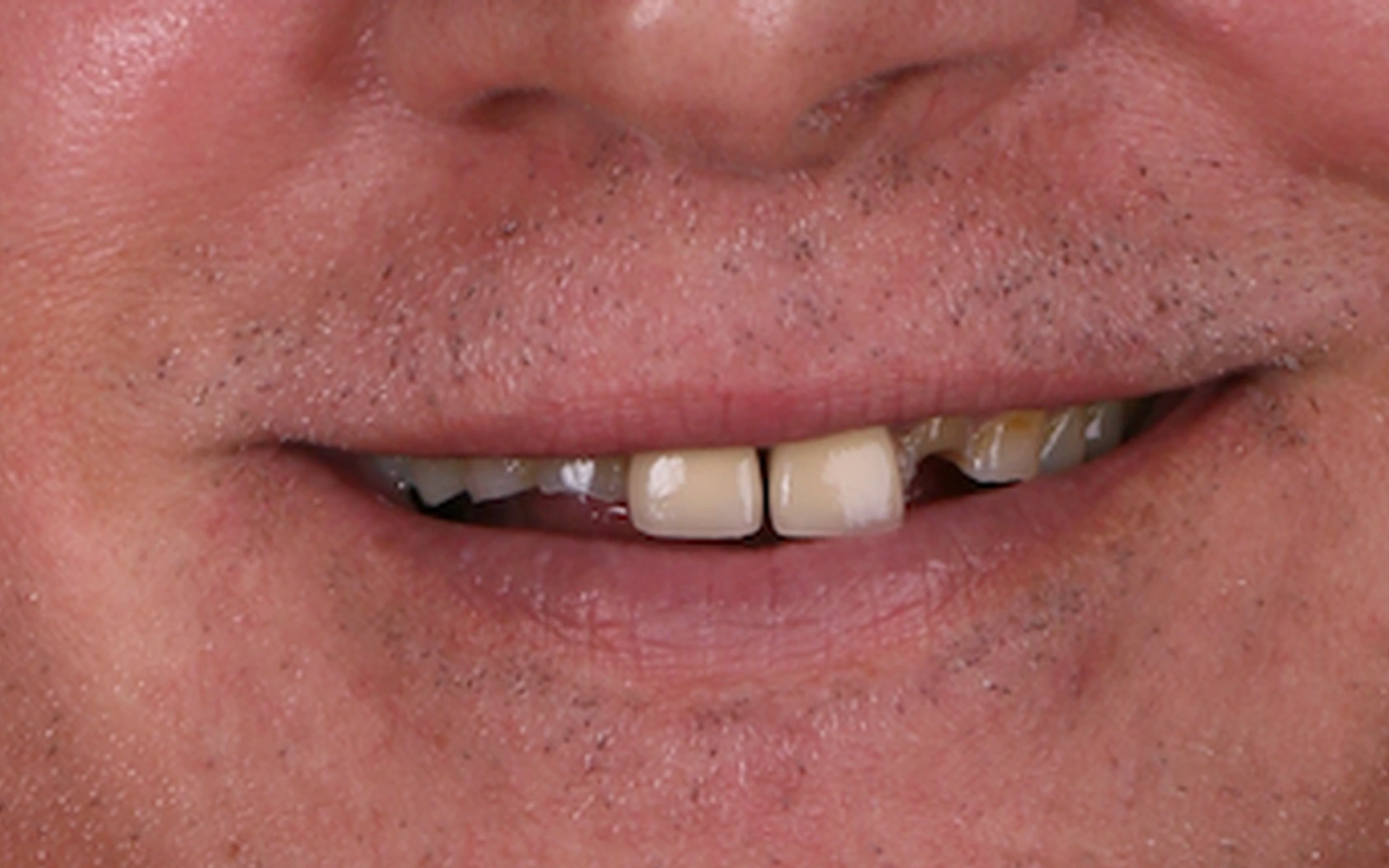 Before: Smile makeover, case 8: broken and missing front teeth