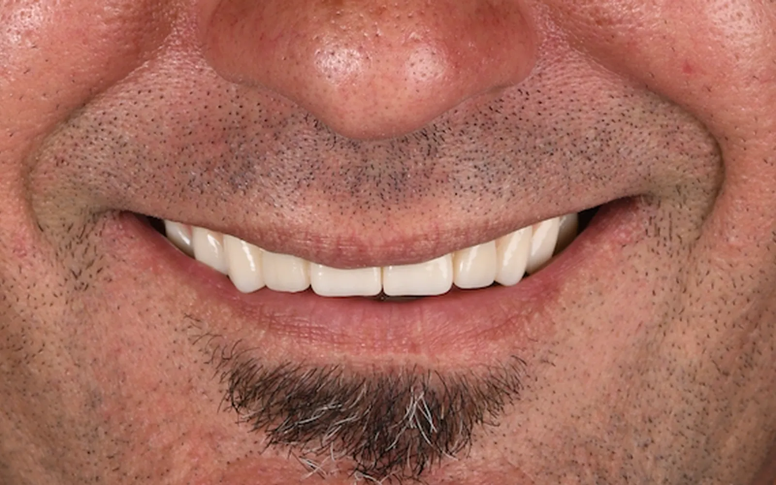 After: Smile makeover, case 9: an even, natural-looking full smile at Cleburne Dental