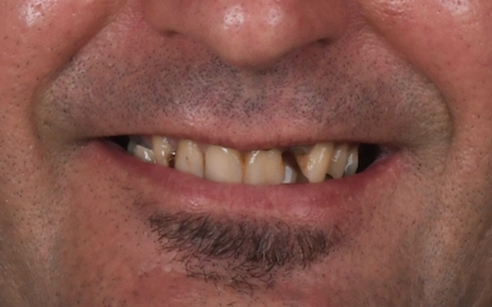 Before: Smile makeover, case 9: worn, chipped and discolored teeth