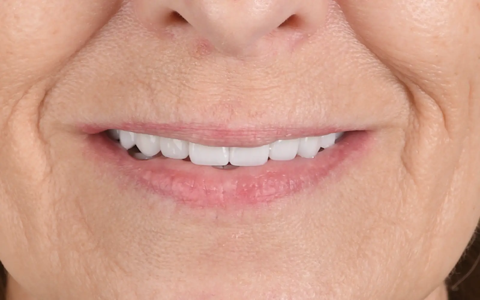 After: Smile makeover, case 11: an even, natural-looking full smile at Cleburne Dental
