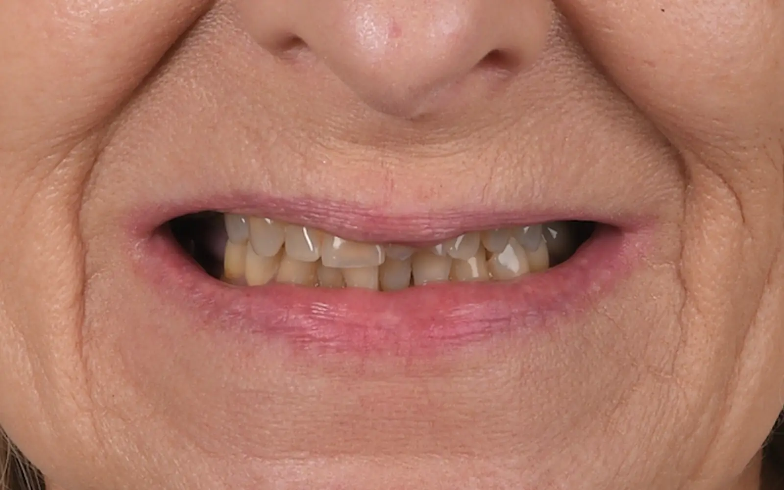 Before: Smile makeover, case 11: worn, crowded and stained teeth