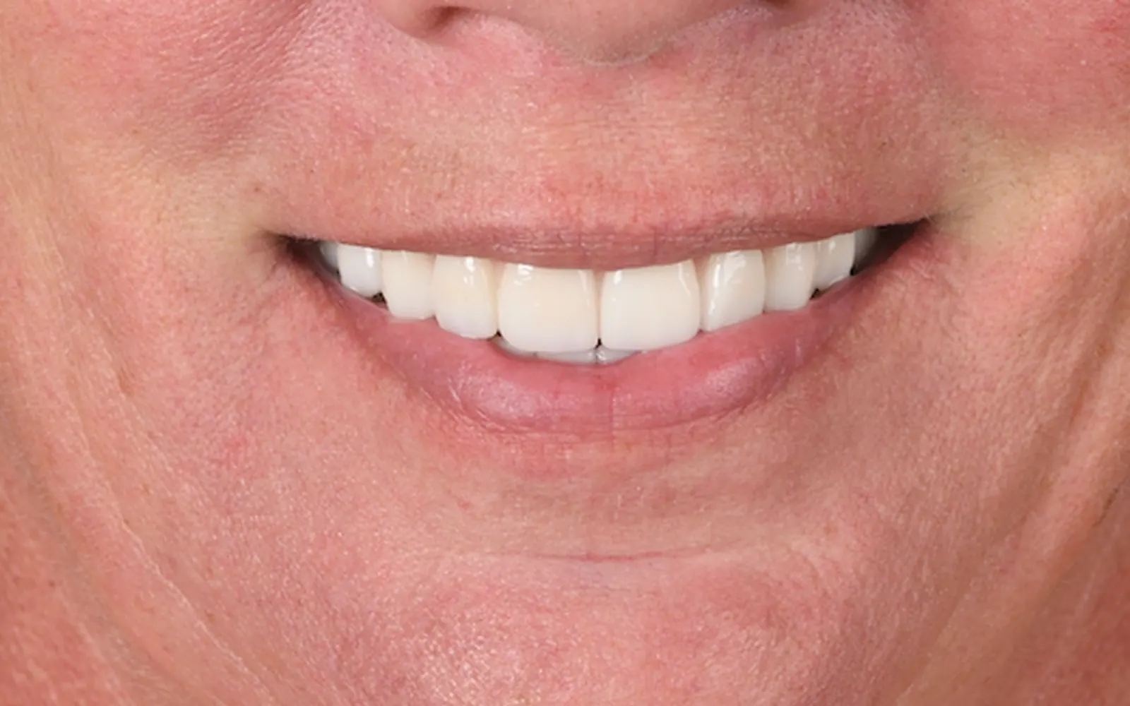 After: Smile makeover, case 19: an even, natural-looking full smile at Cleburne Dental