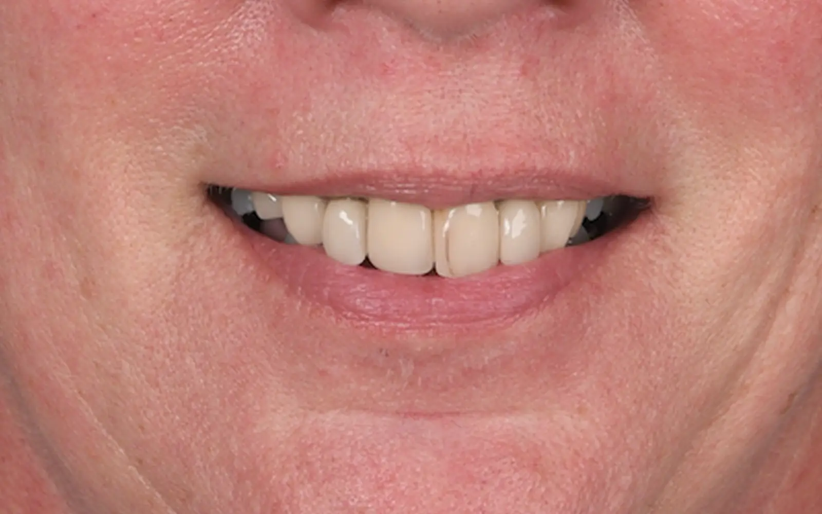 Before: Smile makeover, case 19: aging, discolored front teeth