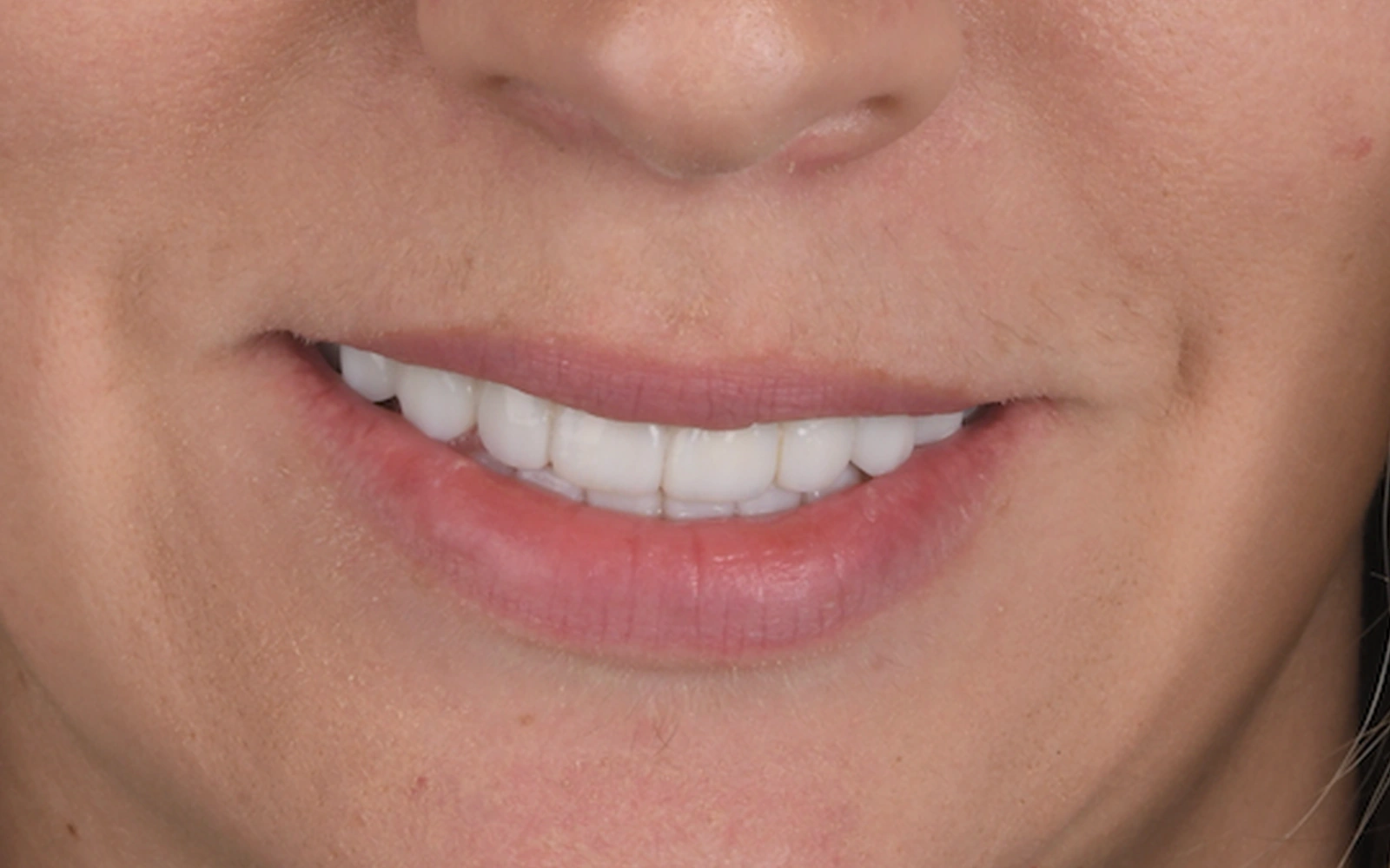 After: Smile makeover, case 2: an even, natural-looking full smile at Cleburne Dental