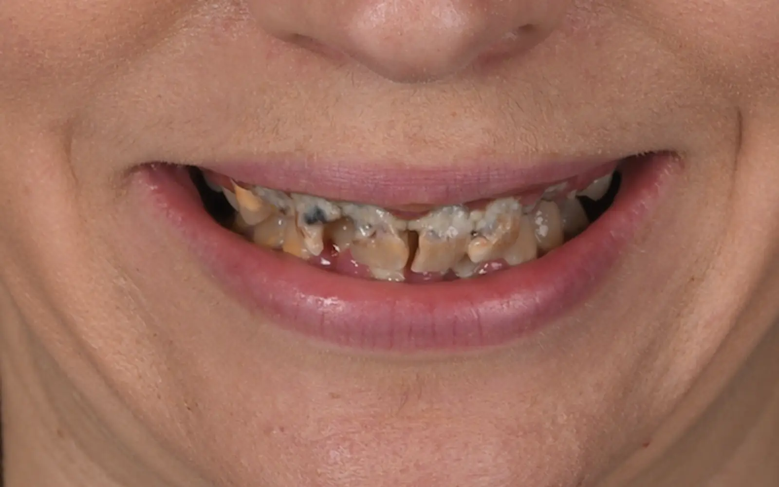 Before: Smile makeover, case 2: severely decayed and broken teeth