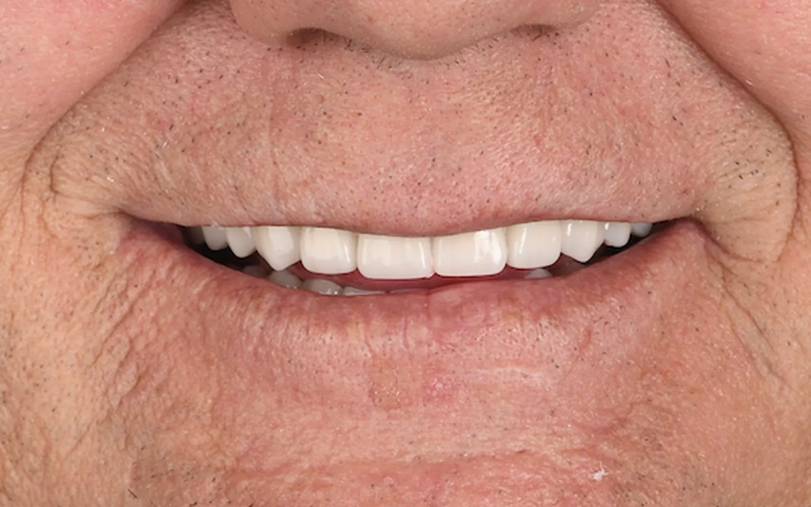After: Smile makeover, case 6: an even, natural-looking full smile at Cleburne Dental