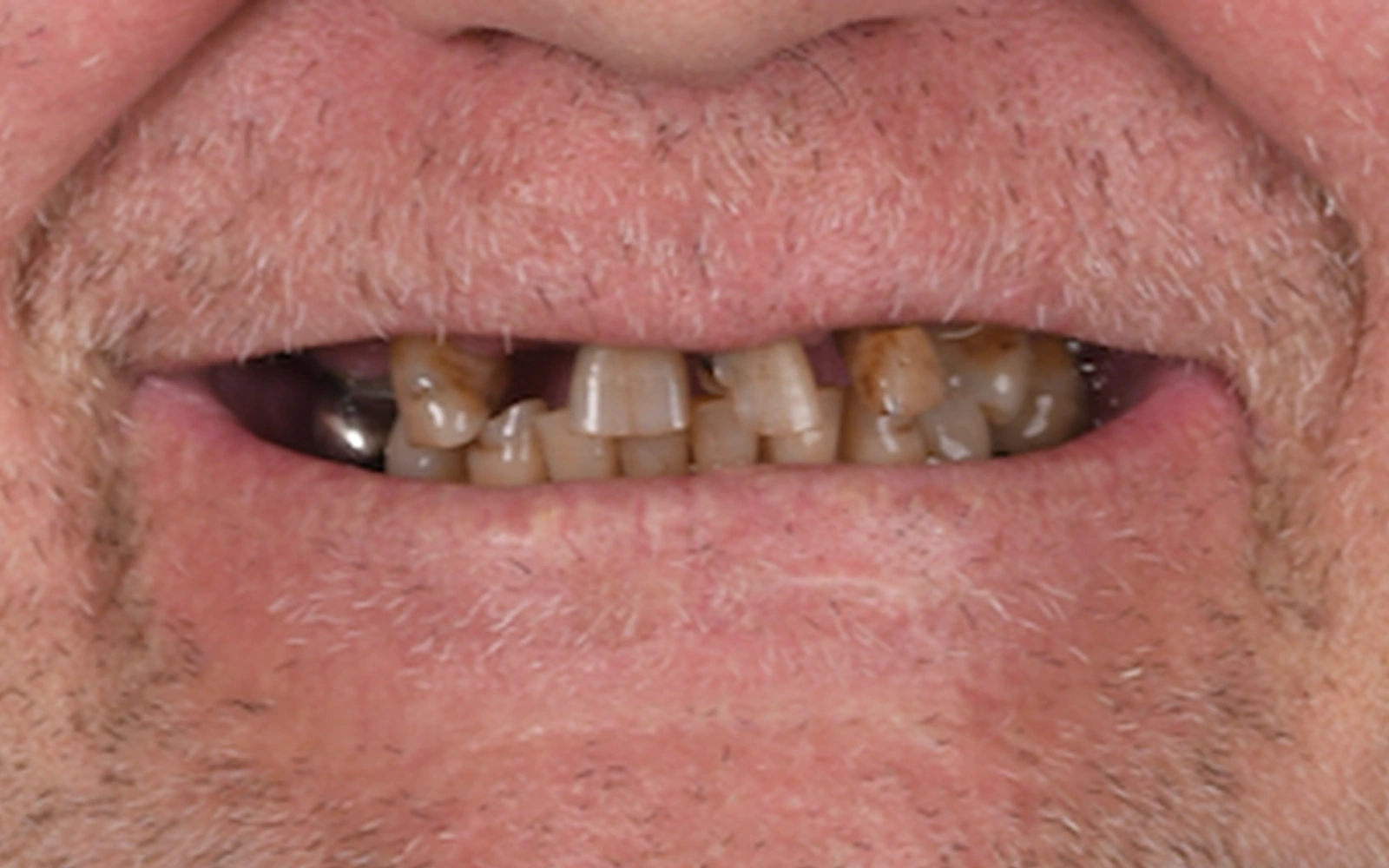 Before: Smile makeover, case 6: decayed, broken and missing teeth