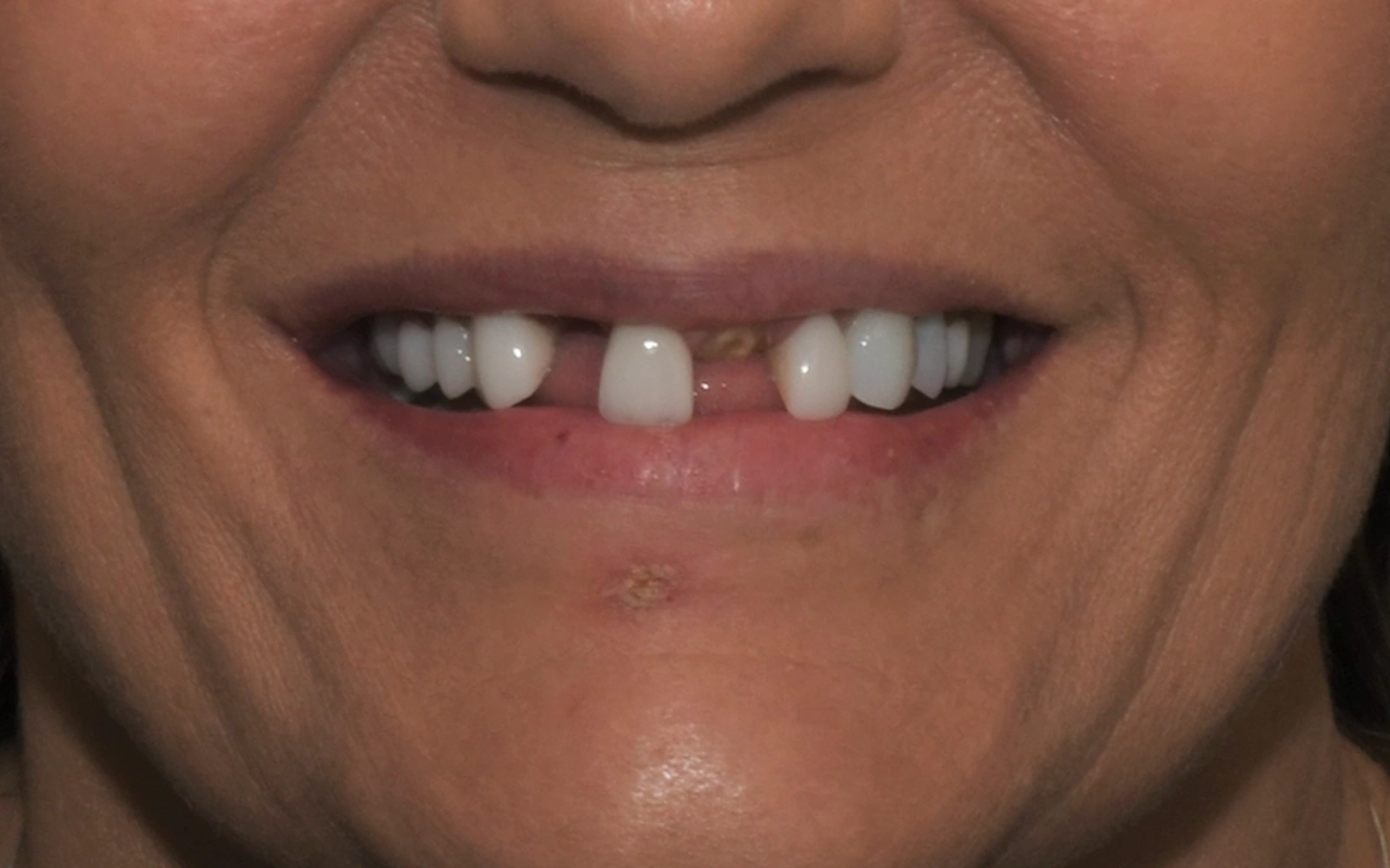 Before: Smile makeover, case 5: several missing front teeth