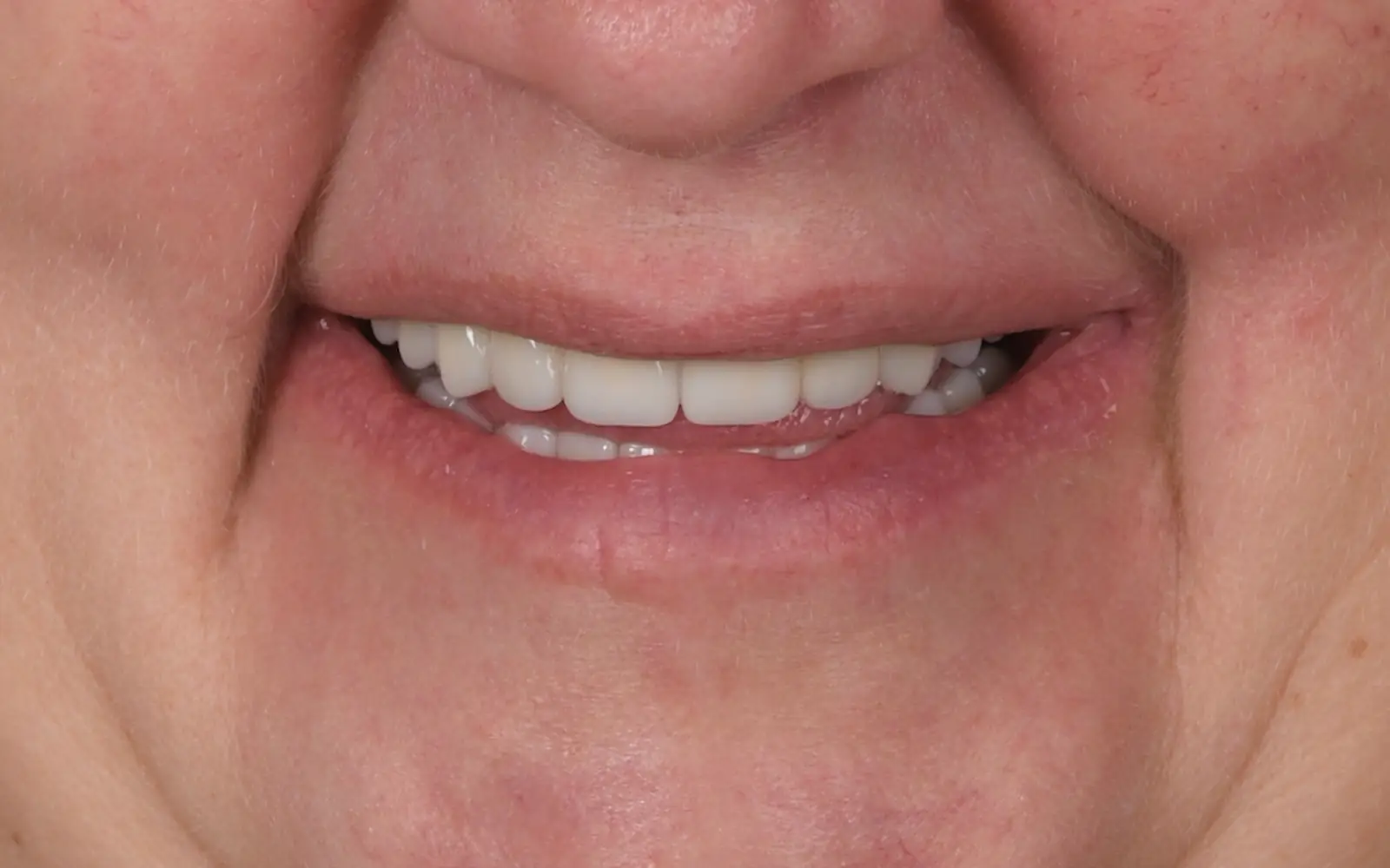 After: Smile makeover, case 16: an even, natural-looking full smile at Cleburne Dental