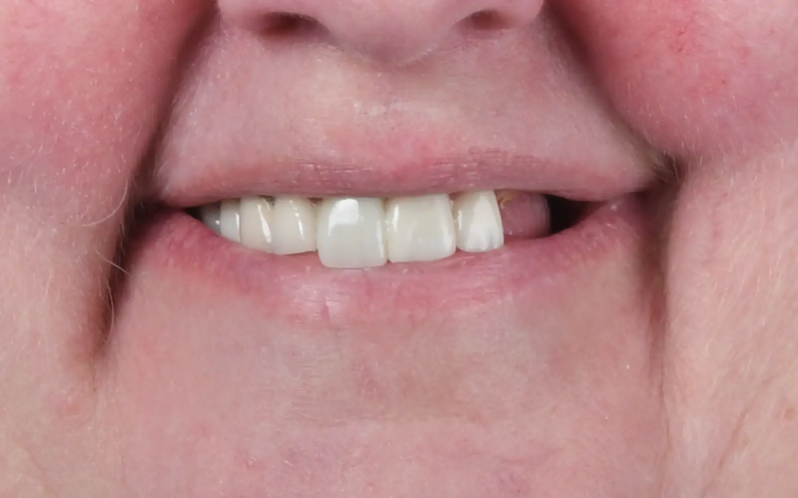 Before: Smile makeover, case 16: mismatched front teeth and a missing side tooth