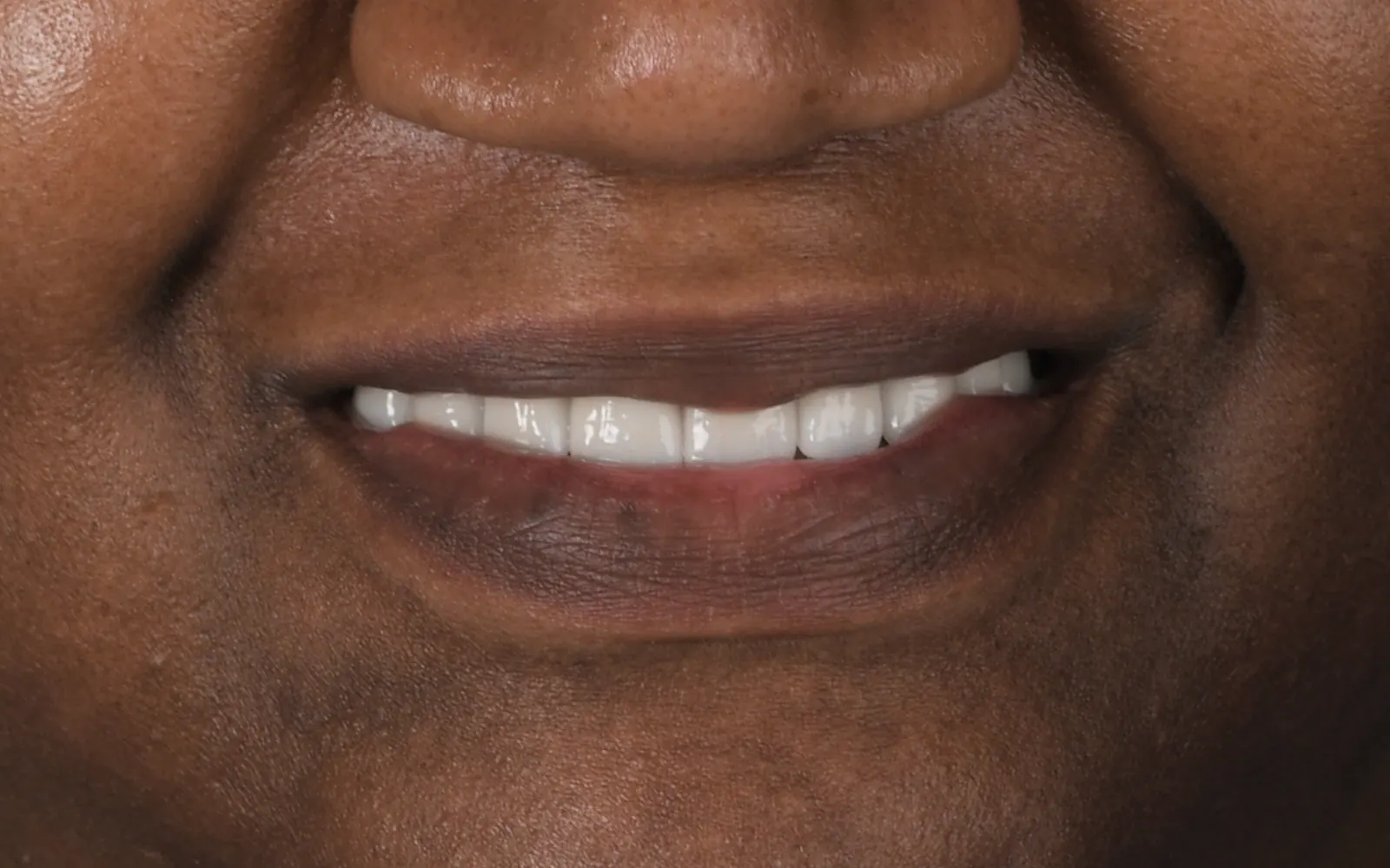 After: Smile makeover, case 17: an even, natural-looking full smile at Cleburne Dental