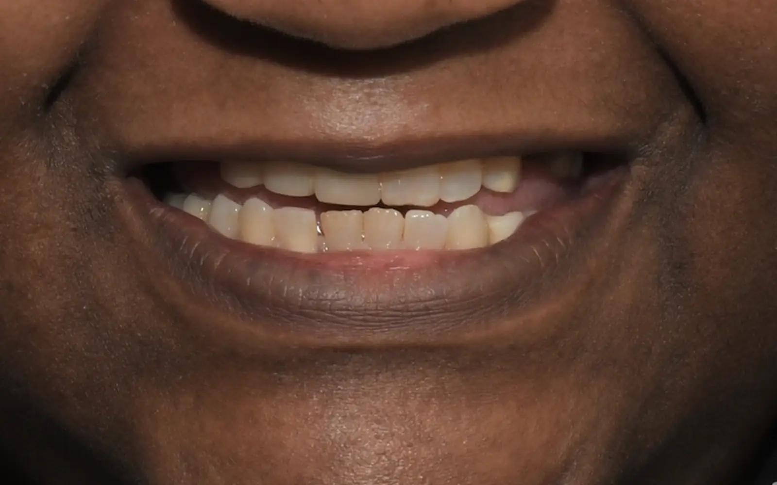 Before: Smile makeover, case 17: worn, crowded and yellowed teeth