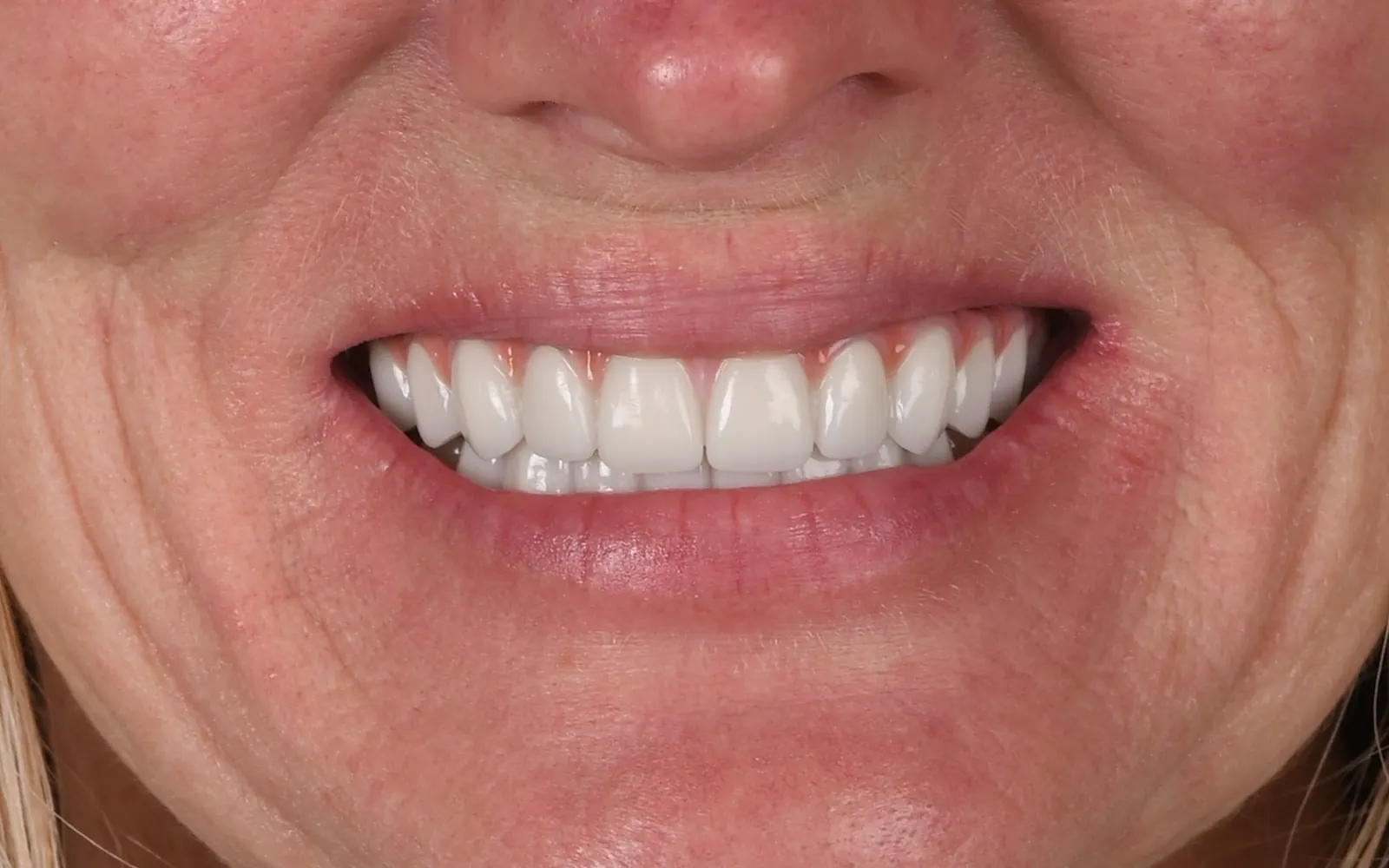 After: Smile makeover, case 20: an even, natural-looking full smile at Cleburne Dental