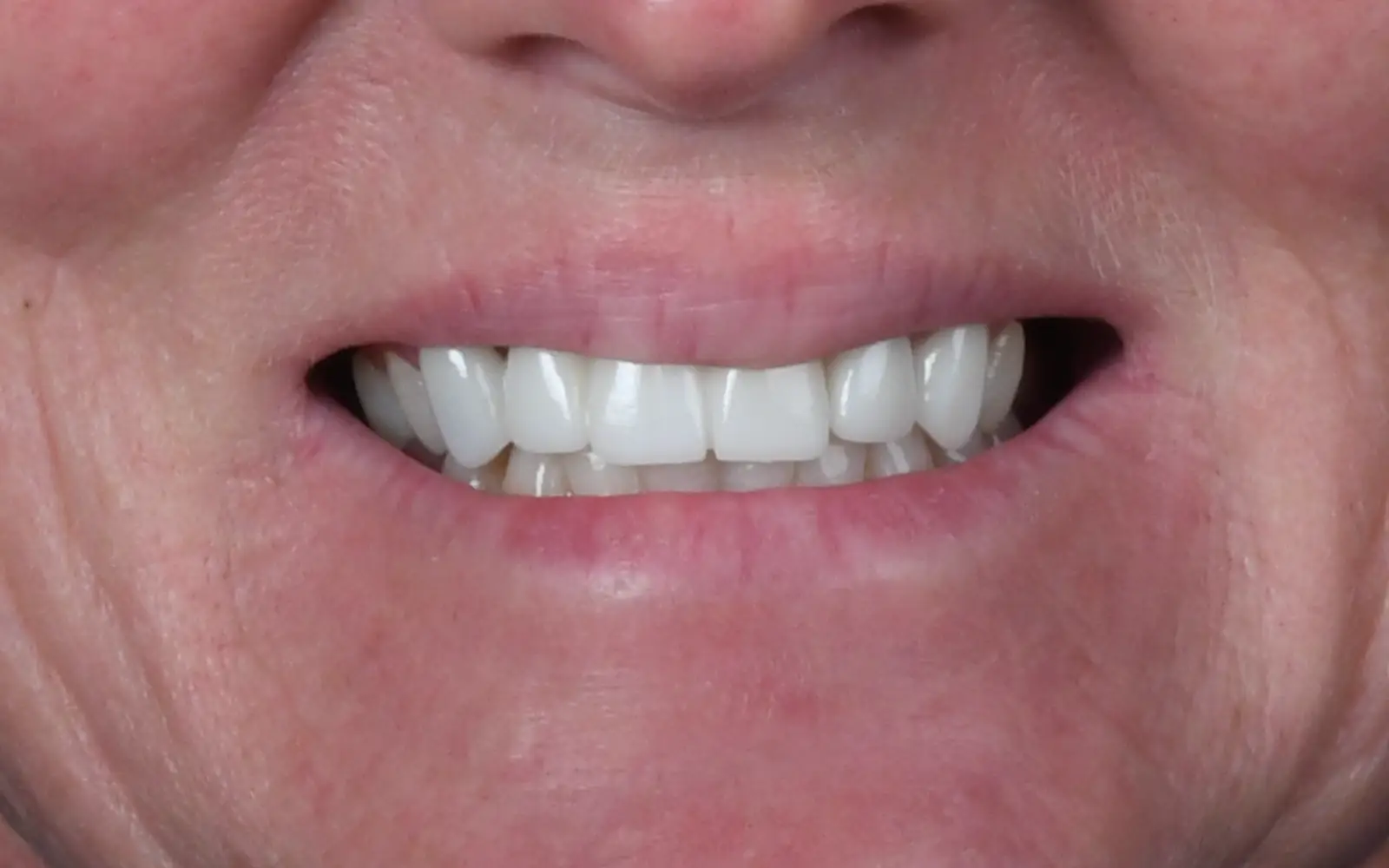 Before: Smile makeover, case 20: older cosmetic work that looked bulky and flat