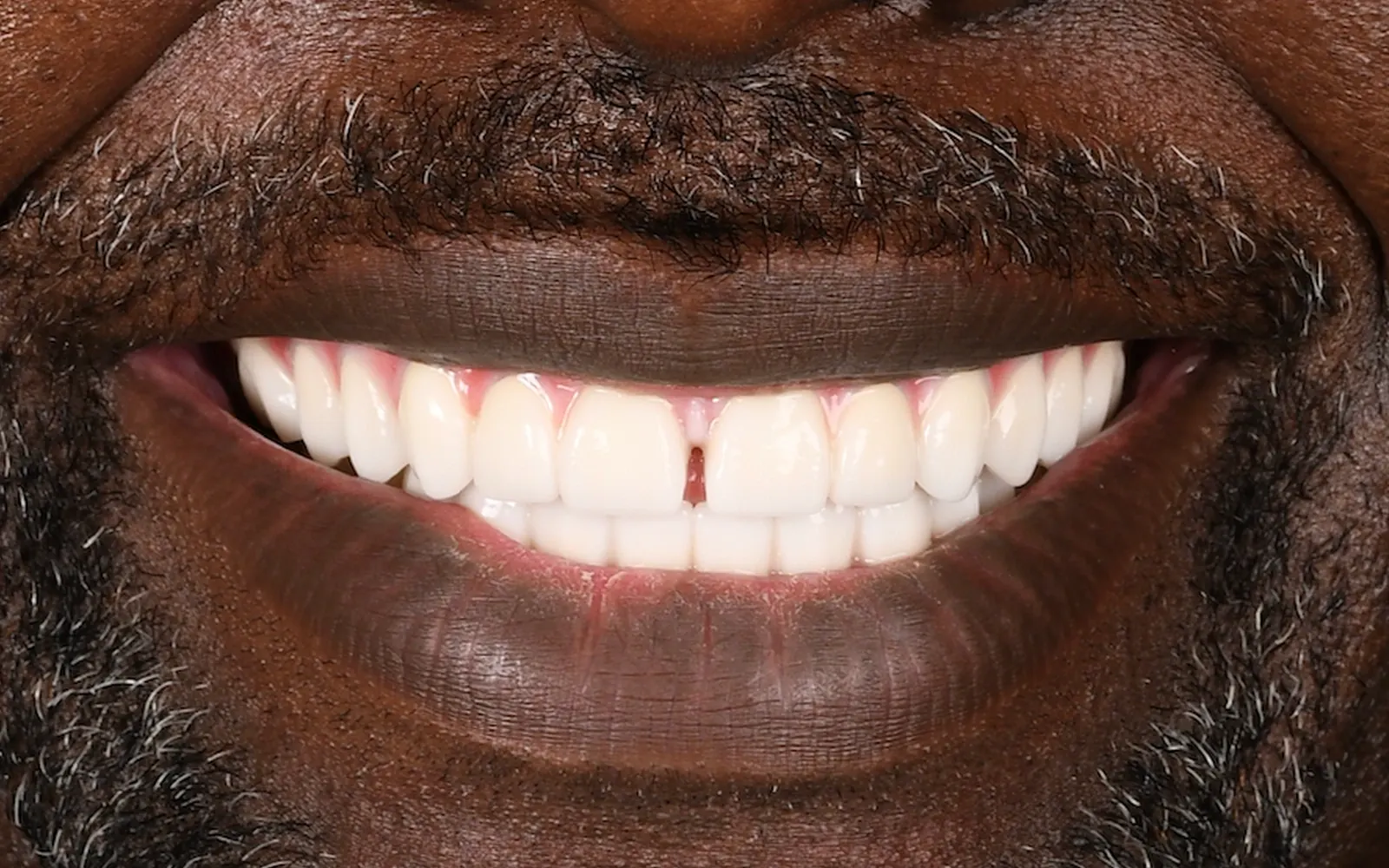 After: Smile makeover, case 4: an even, natural-looking full smile at Cleburne Dental