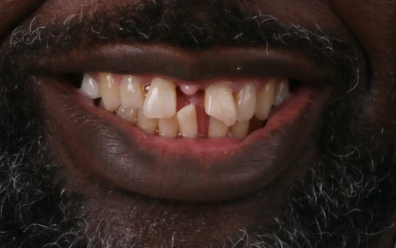 Before: Smile makeover, case 4: crowded, crooked front teeth with gaps