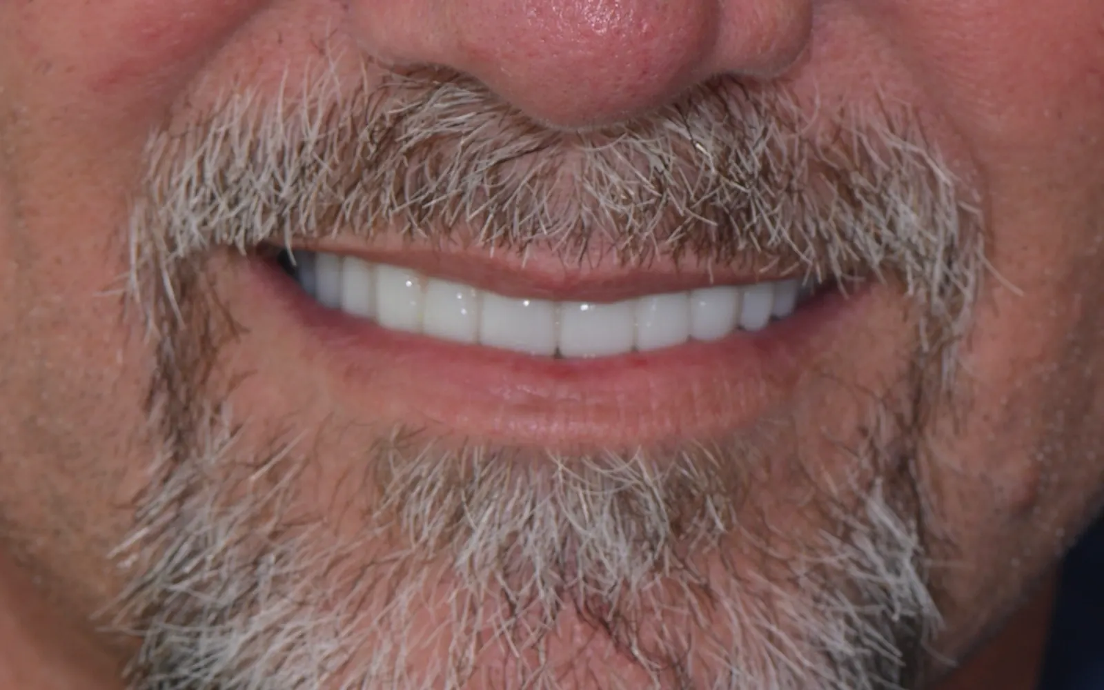 After: Smile makeover, case 12: an even, natural-looking full smile at Cleburne Dental
