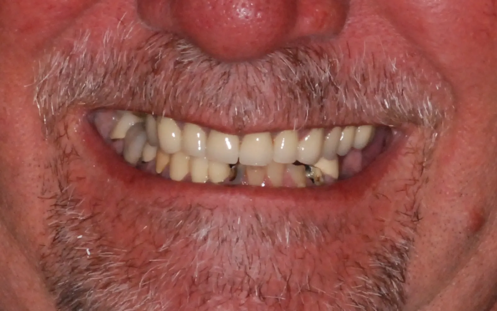 Before: Smile makeover, case 12: older dental work with metal showing and missing teeth