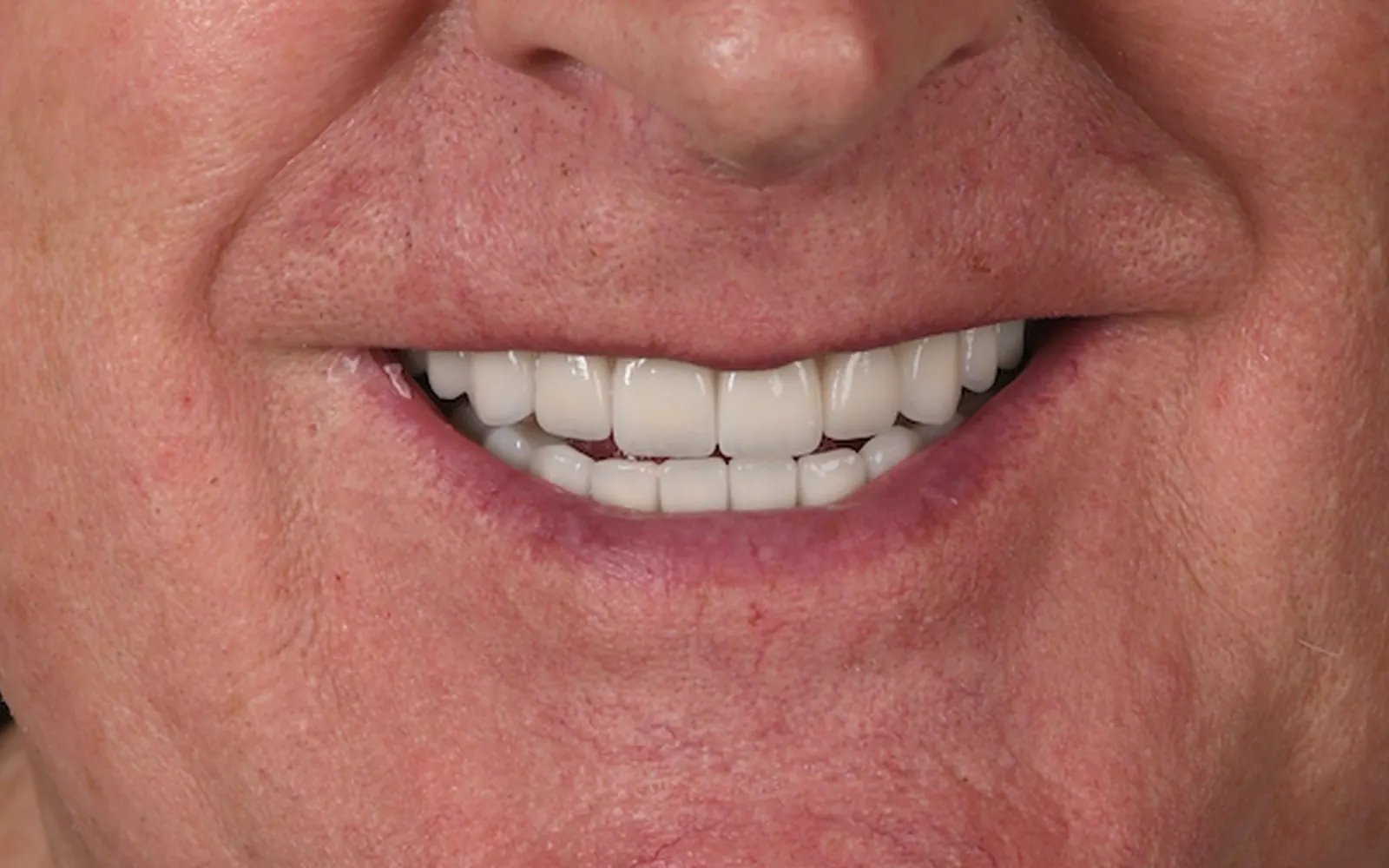 After: Smile makeover, case 15: an even, natural-looking full smile at Cleburne Dental