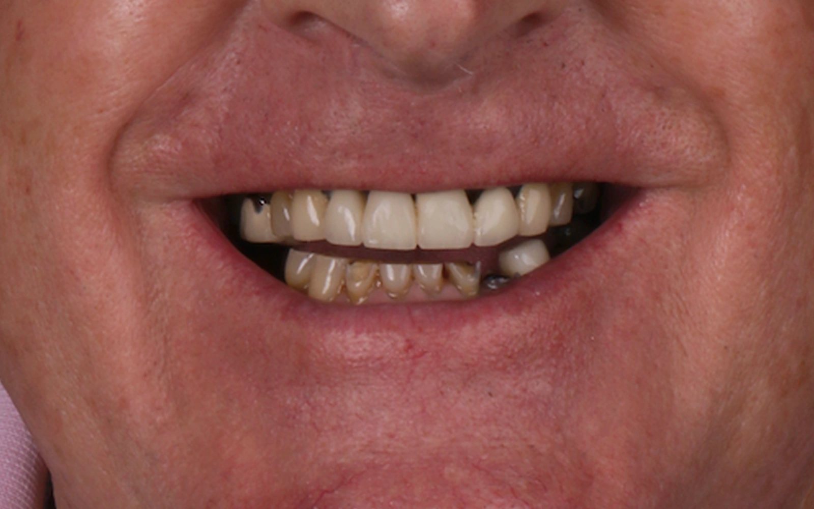 Before: Smile makeover, case 15: worn, discolored upper and lower teeth