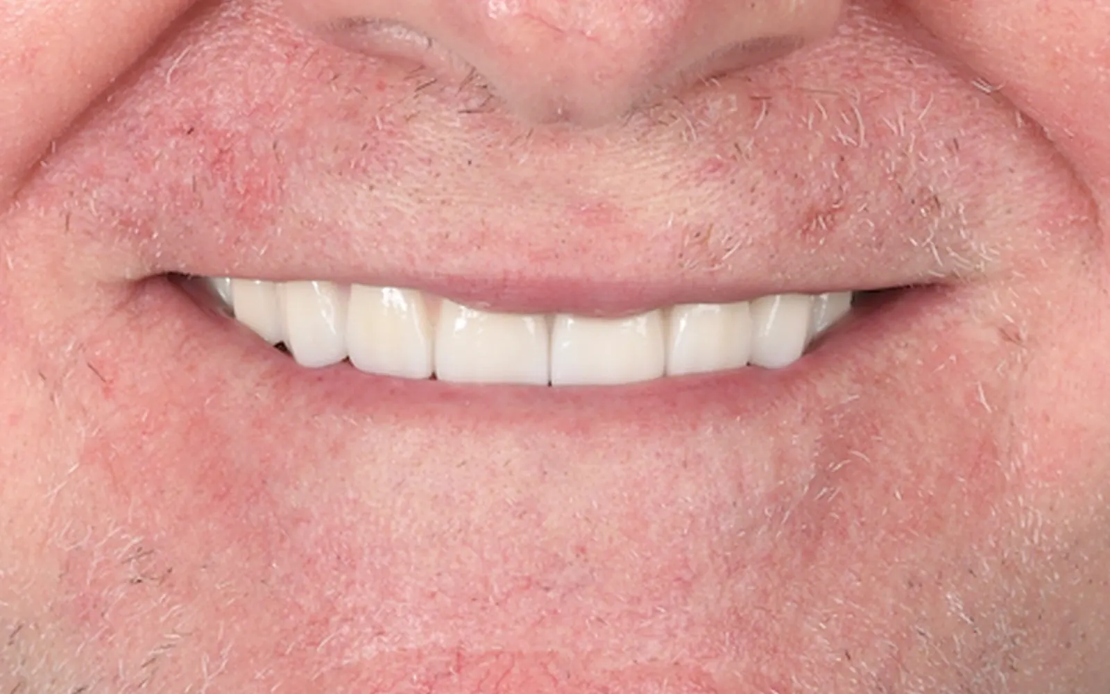 After: Smile makeover, case 10: an even, natural-looking full smile at Cleburne Dental