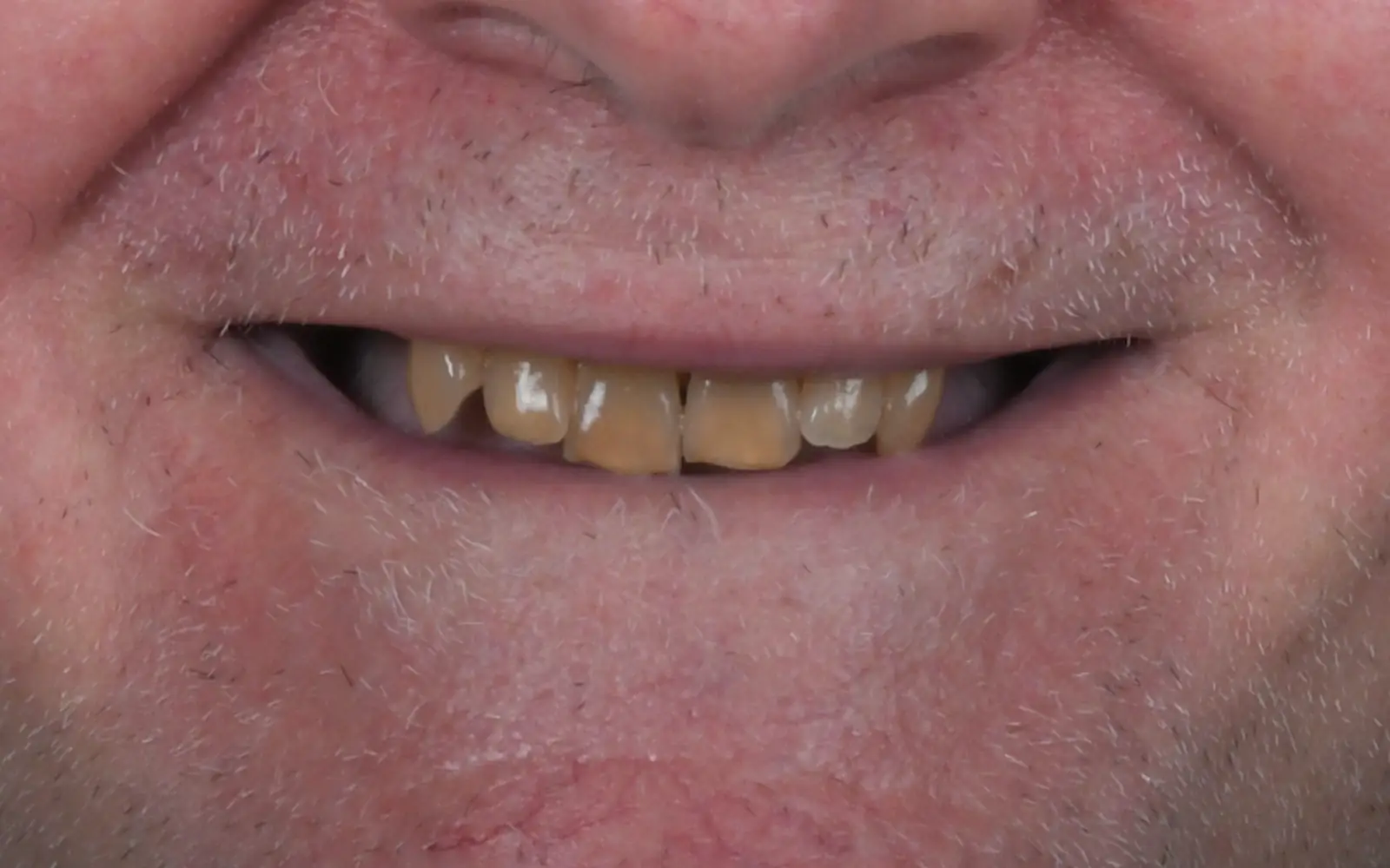 Before: Smile makeover, case 10: dark, heavily stained teeth