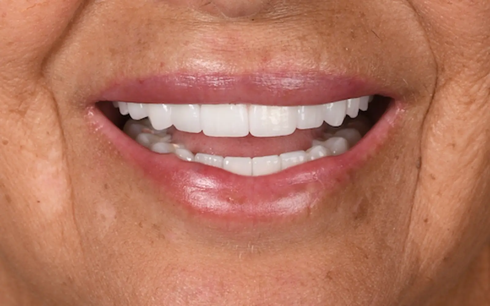 After: Smile makeover, case 13: an even, natural-looking full smile at Cleburne Dental