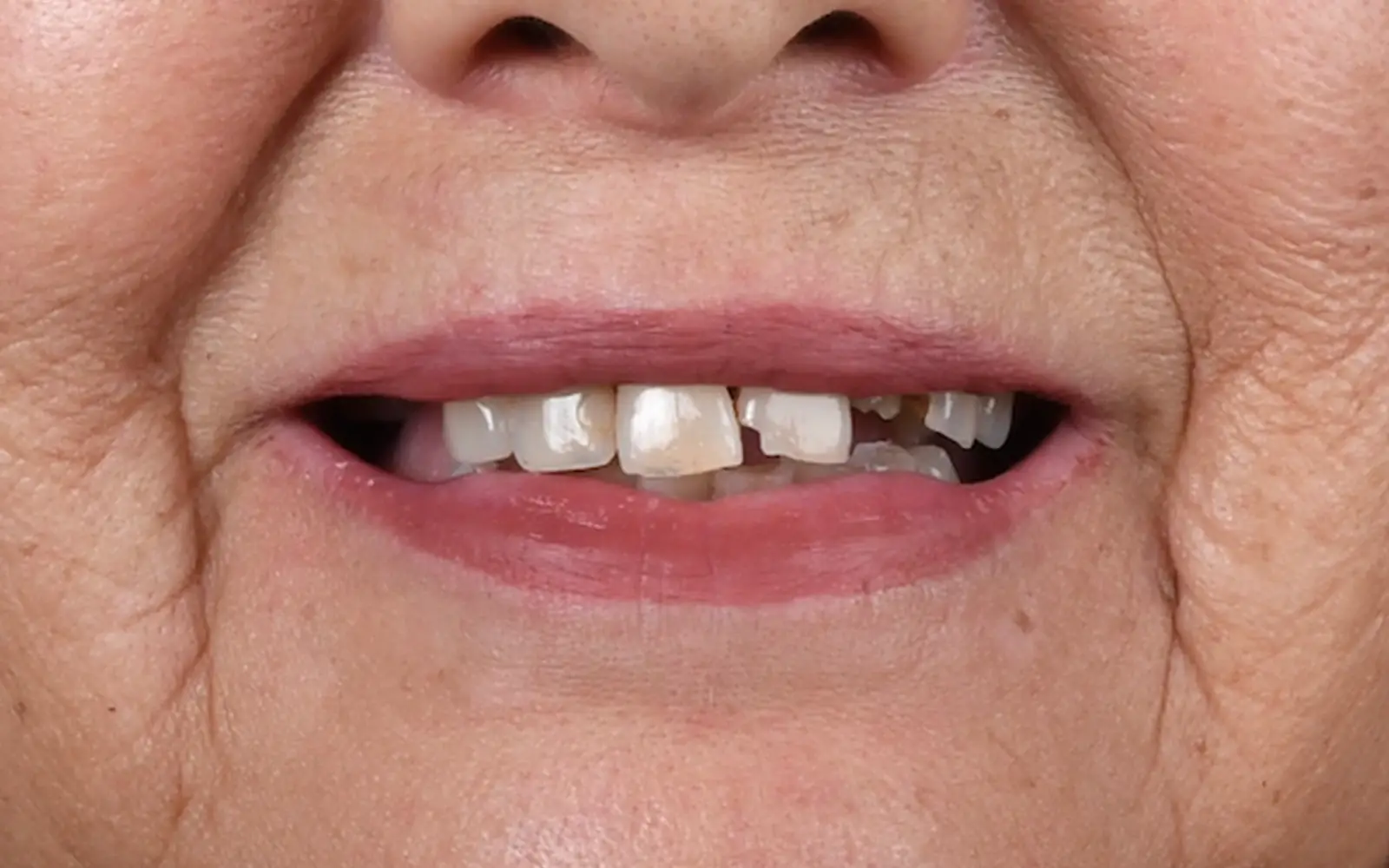 Before: Smile makeover, case 13: missing, chipped and uneven teeth
