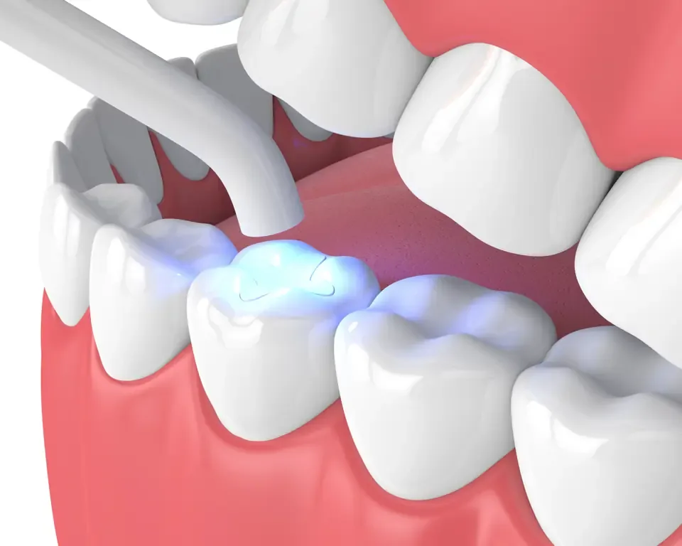 Illustration of a curing light hardening a tooth-colored filling on a back tooth