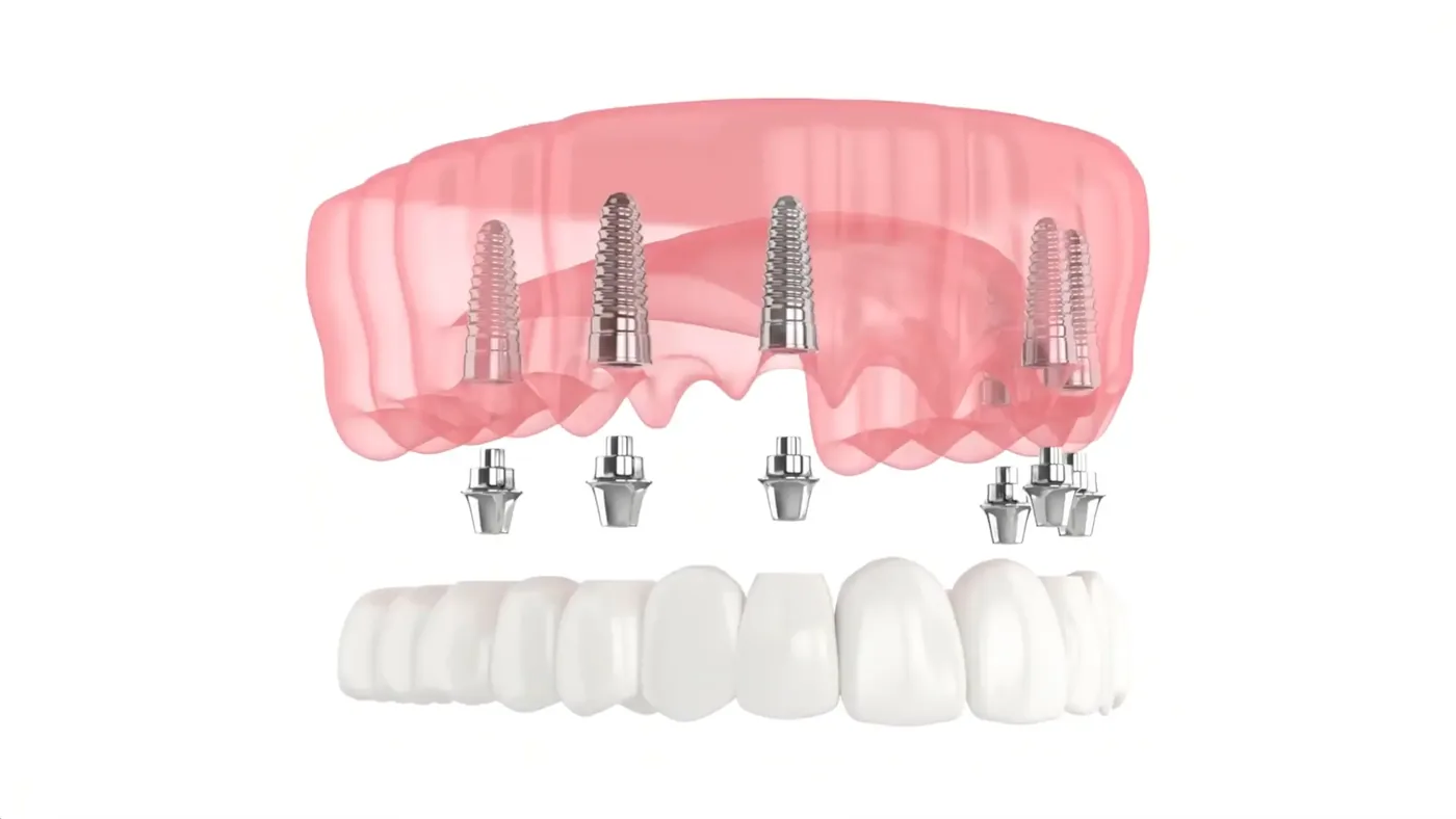 Model of a jaw with several dental implants supporting a full row of replacement teeth