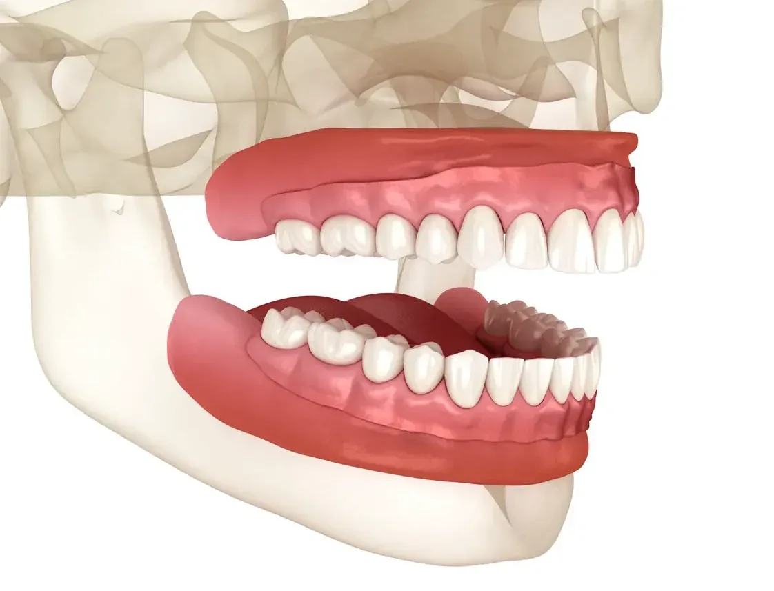 Illustration of complete upper and lower dentures fitted over the gums in a model of the jaws