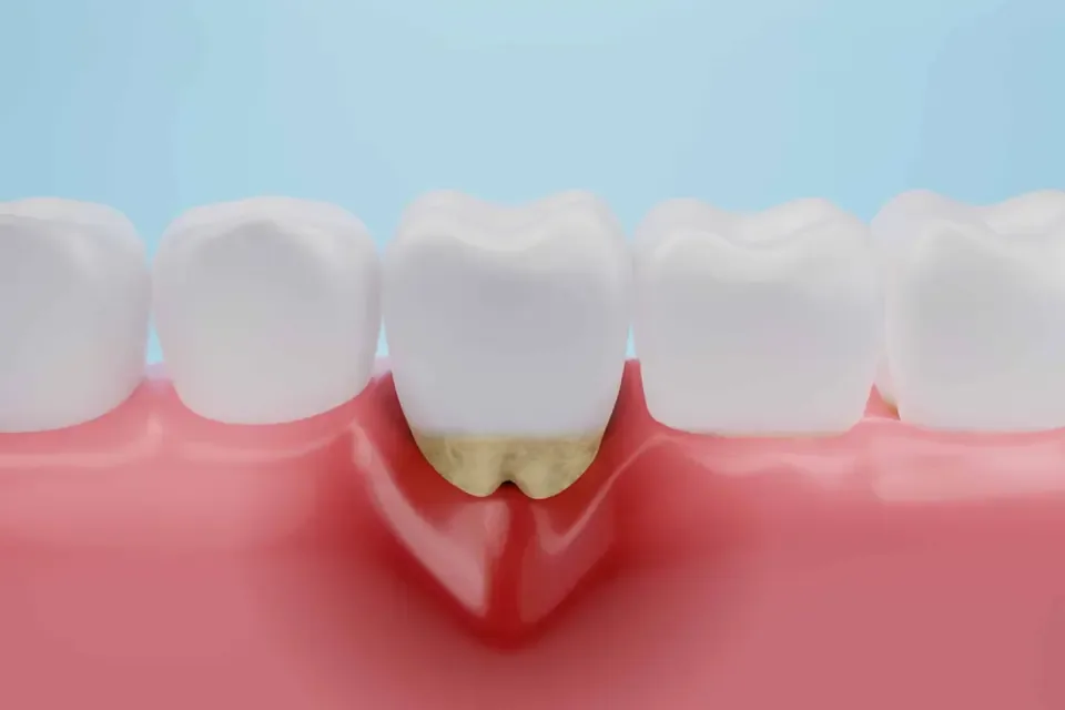 Illustration of inflamed gums pulling away from a tooth, with tartar below the gumline
