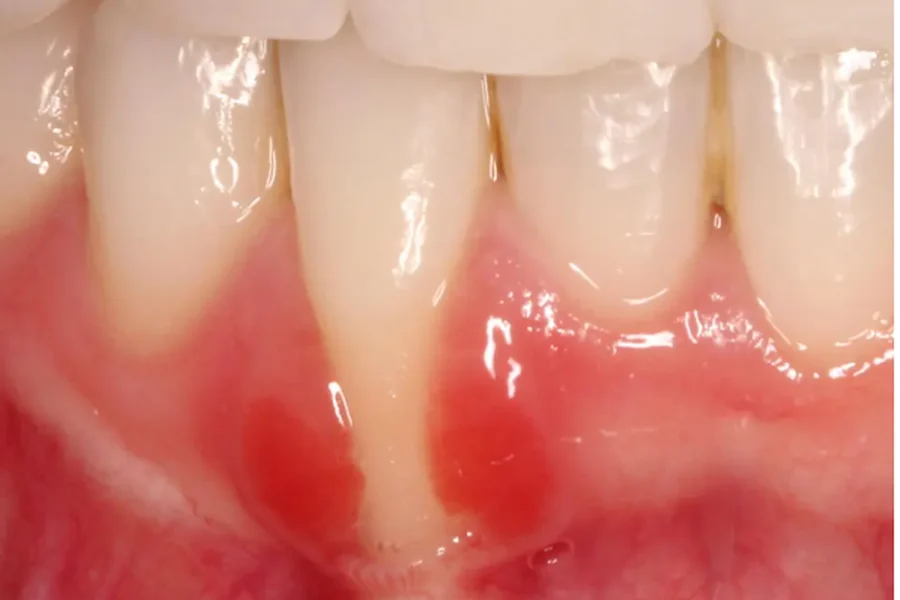 Close-up of receding gums exposing the root of a lower front tooth