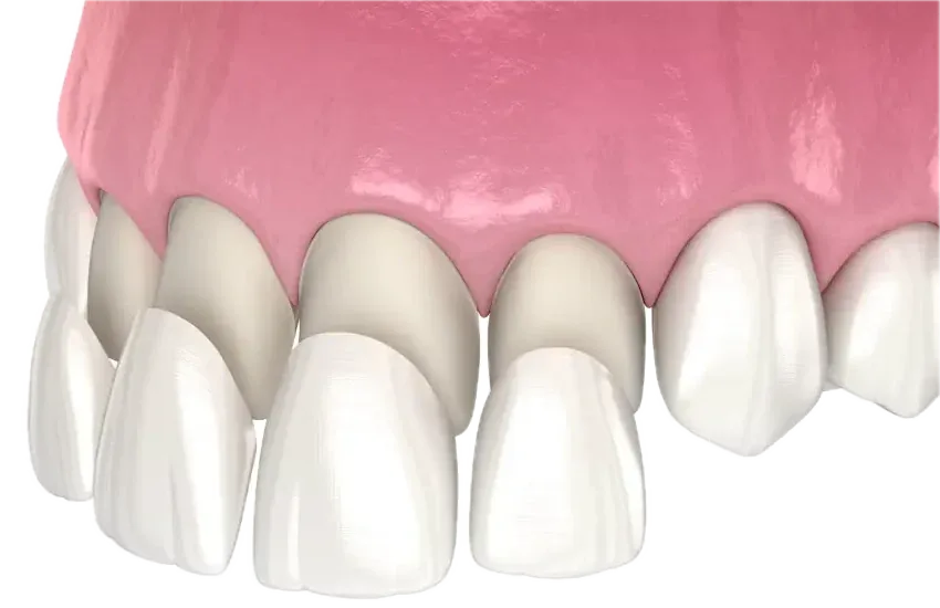 Illustration of thin porcelain veneers over the upper front teeth